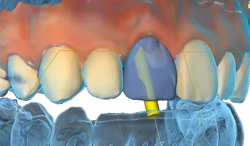 D'Amico Dental Care - Expert Planning for Complex Implants | D’Amico Dental Care - When implant treatment is described as “complex,” patients usually feel one thing before anything else: uncertainty.At D’Amico Dental Care, complex implant cases are approached with a fundamentally different mindset.More precise.More structured.More predictable before treatment begins.This page exists to explain how predictability is built, step by step, before any irreversible decision is made.