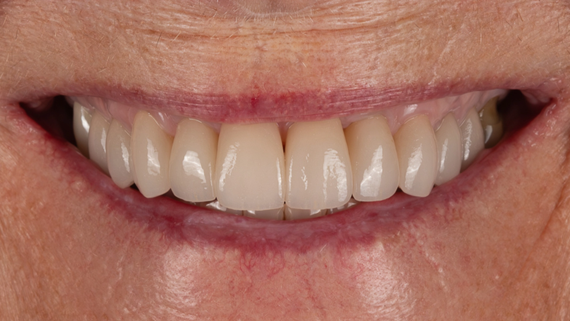 smile after