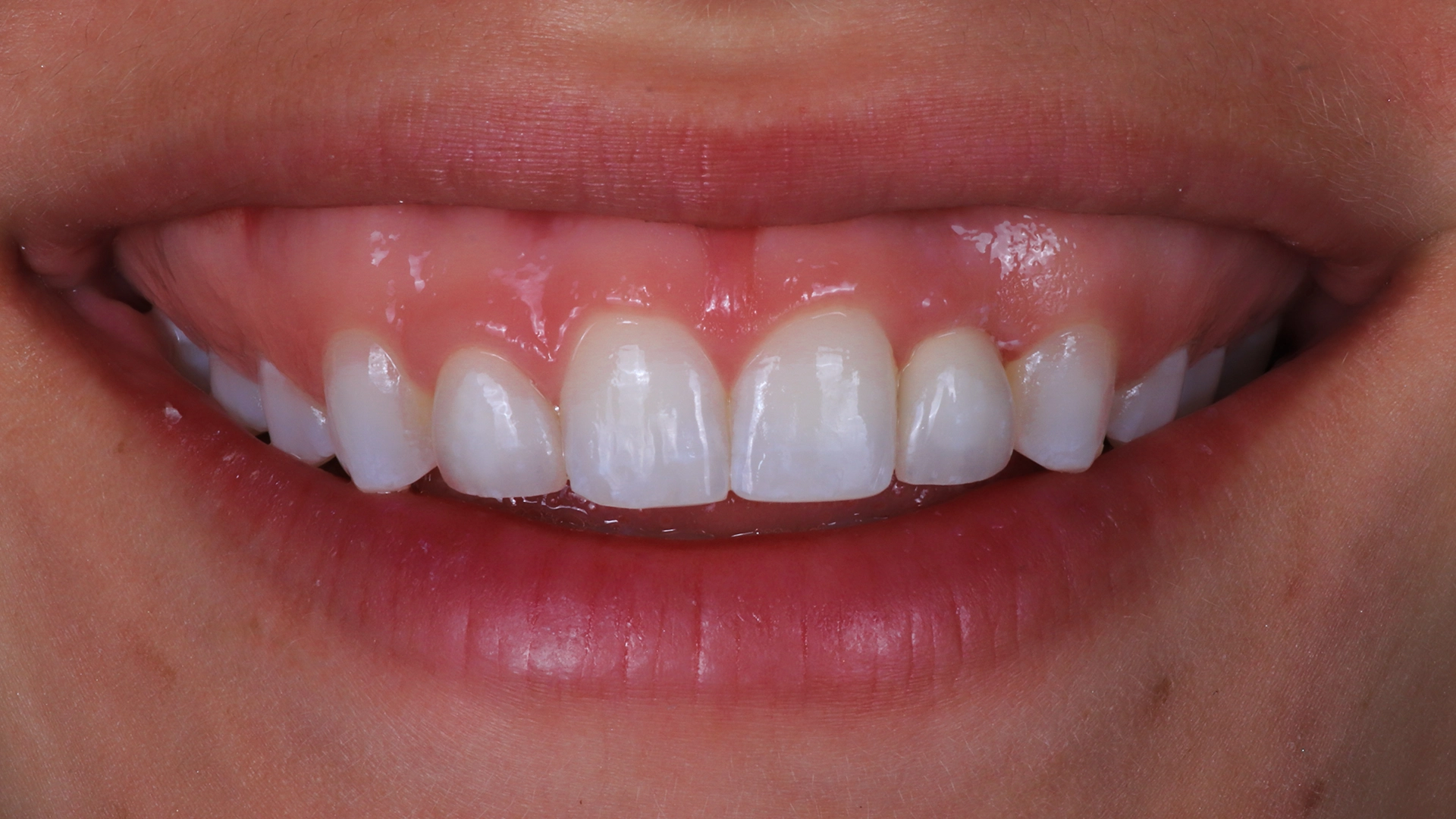 smile after