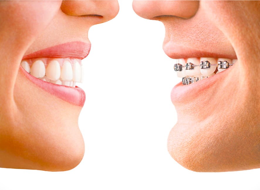 Clear aligners compared to traditional braces at D'Amico Dental Care