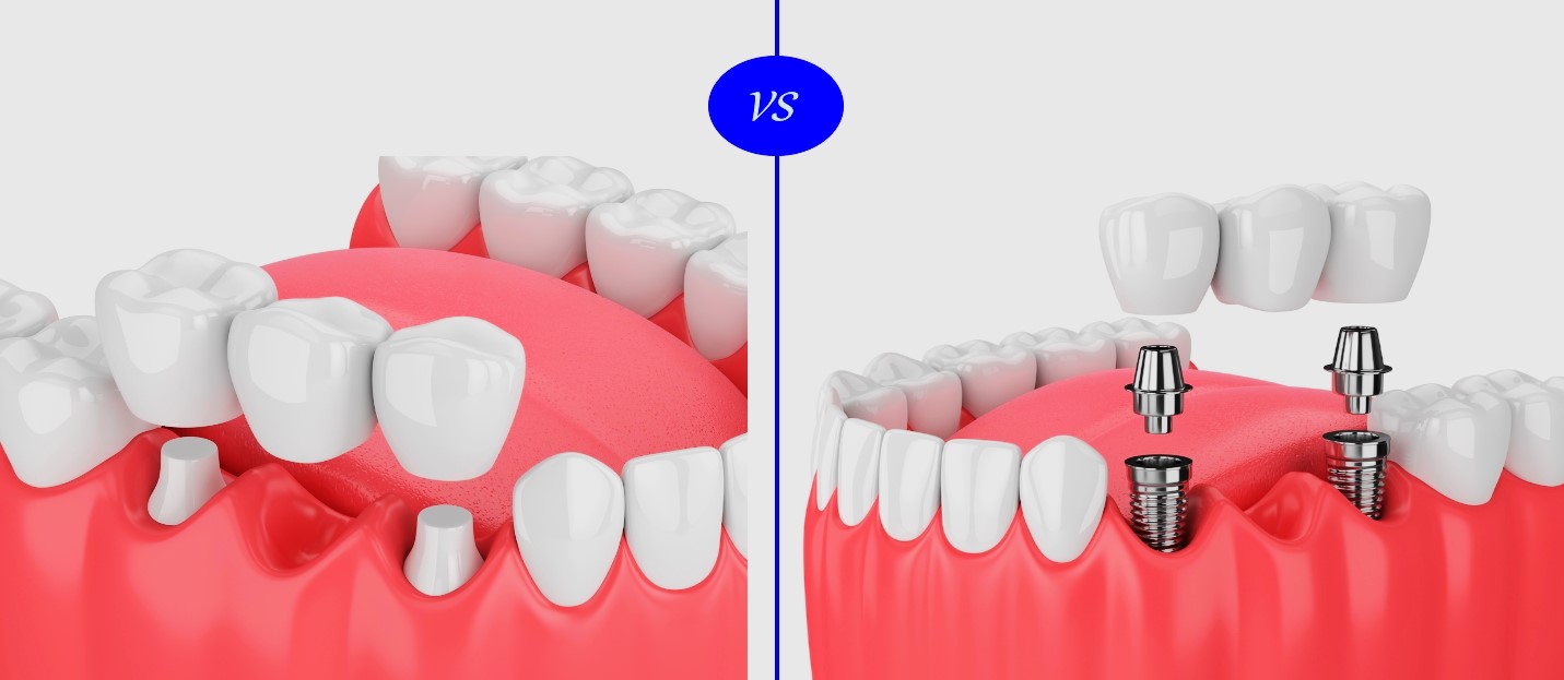 Dental Implants vs Dental Bridges comparison
