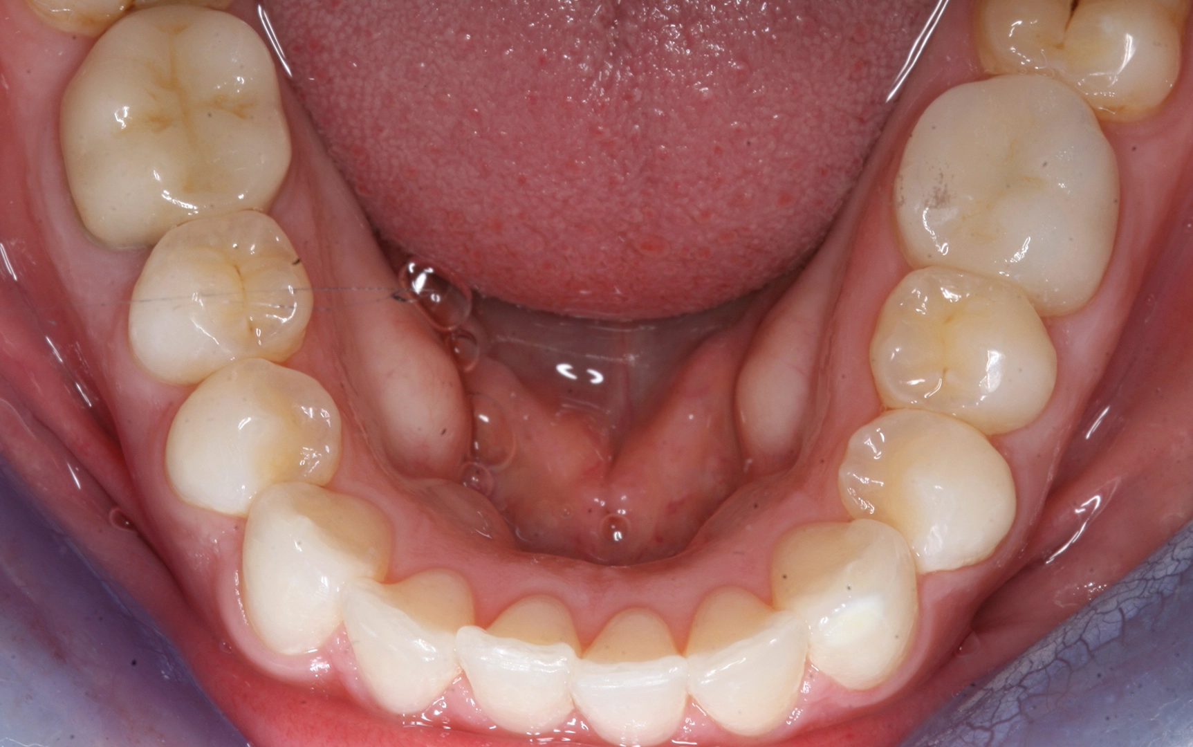 L jaw after