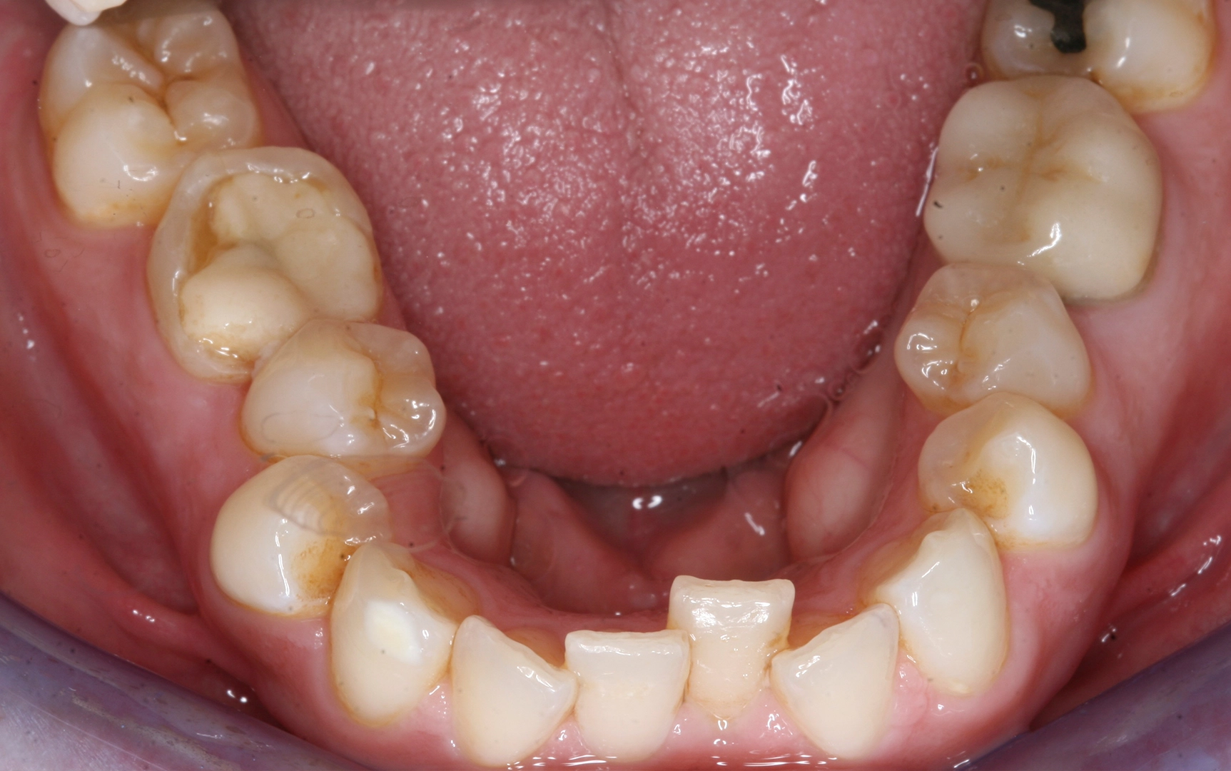 L jaw before L jaw before