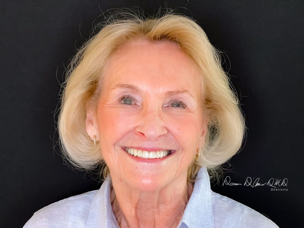 Smile gallery result 4 — completed dental treatment at D'Amico Dental Care