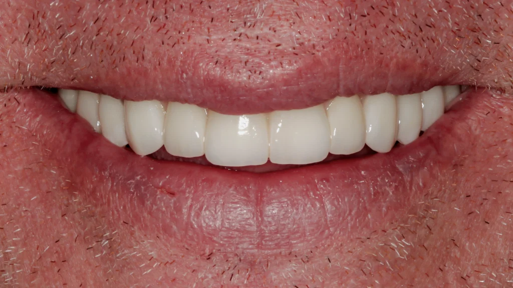D'Amico Dental Care - Why Dental Implants Fail: The Hidden Clinical, Biological & Human Factors Most Dentists Never Explain - Most dental implant failures are not random accidents.