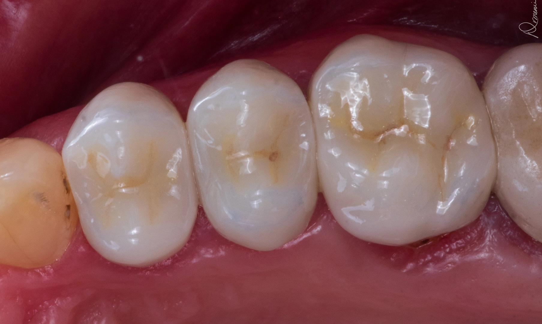 After same-day crown