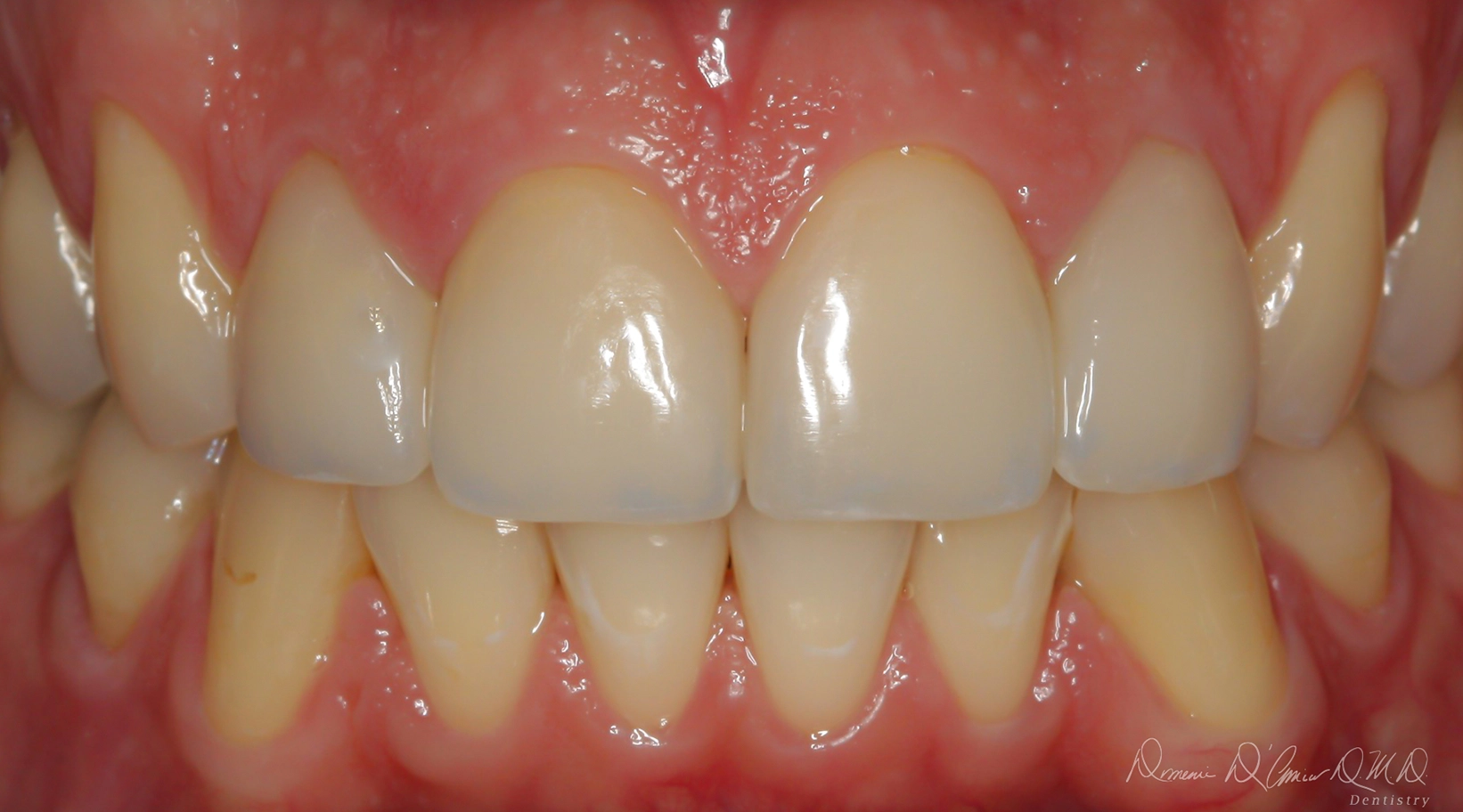 After dental veneer placement – perfectly shaped and colored teeth