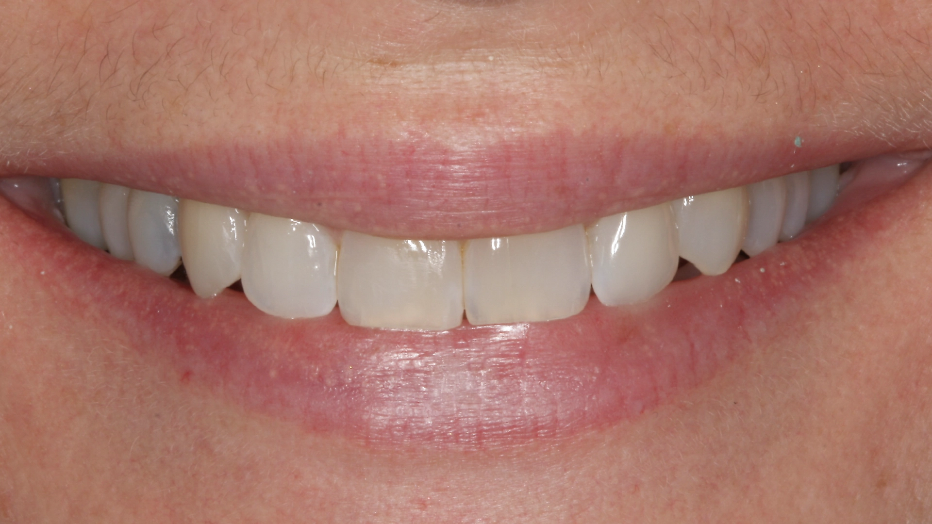 after smile