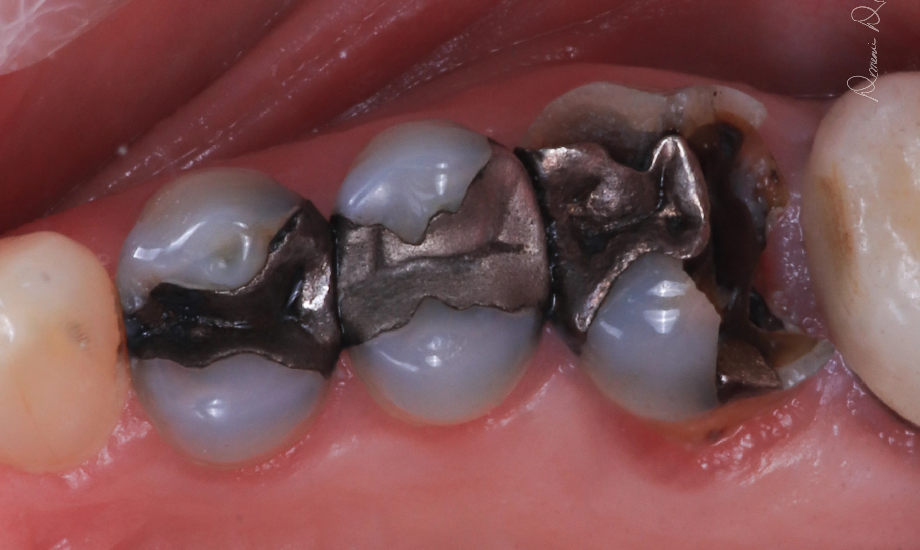 Before same-day crown treatment
