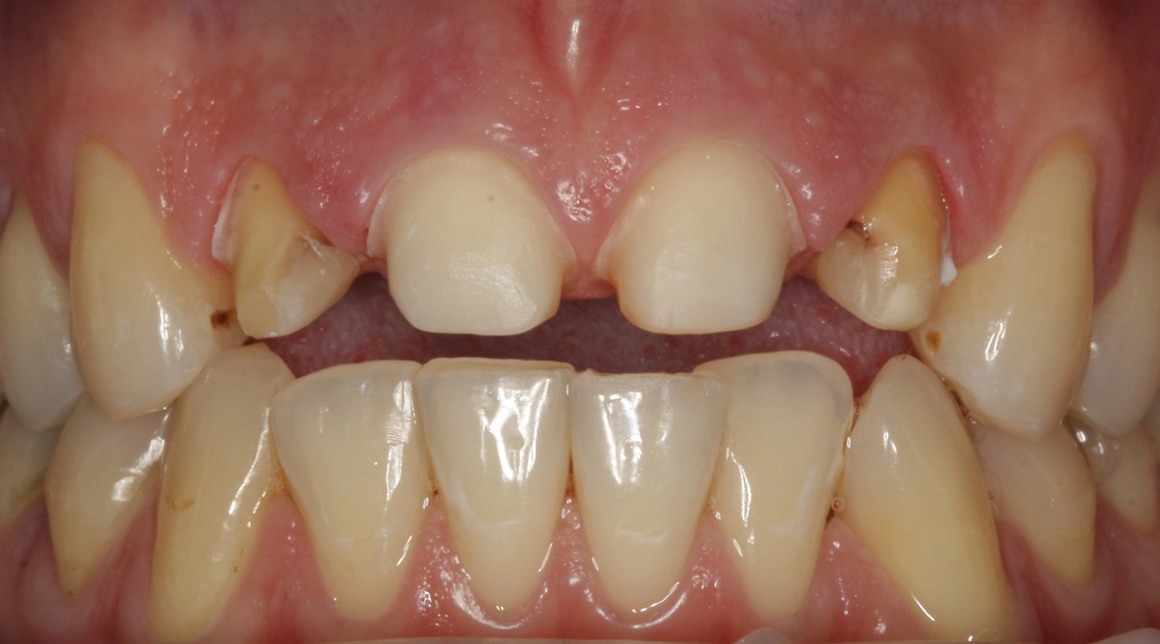 Before dental veneer treatment – worn and discolored front teeth