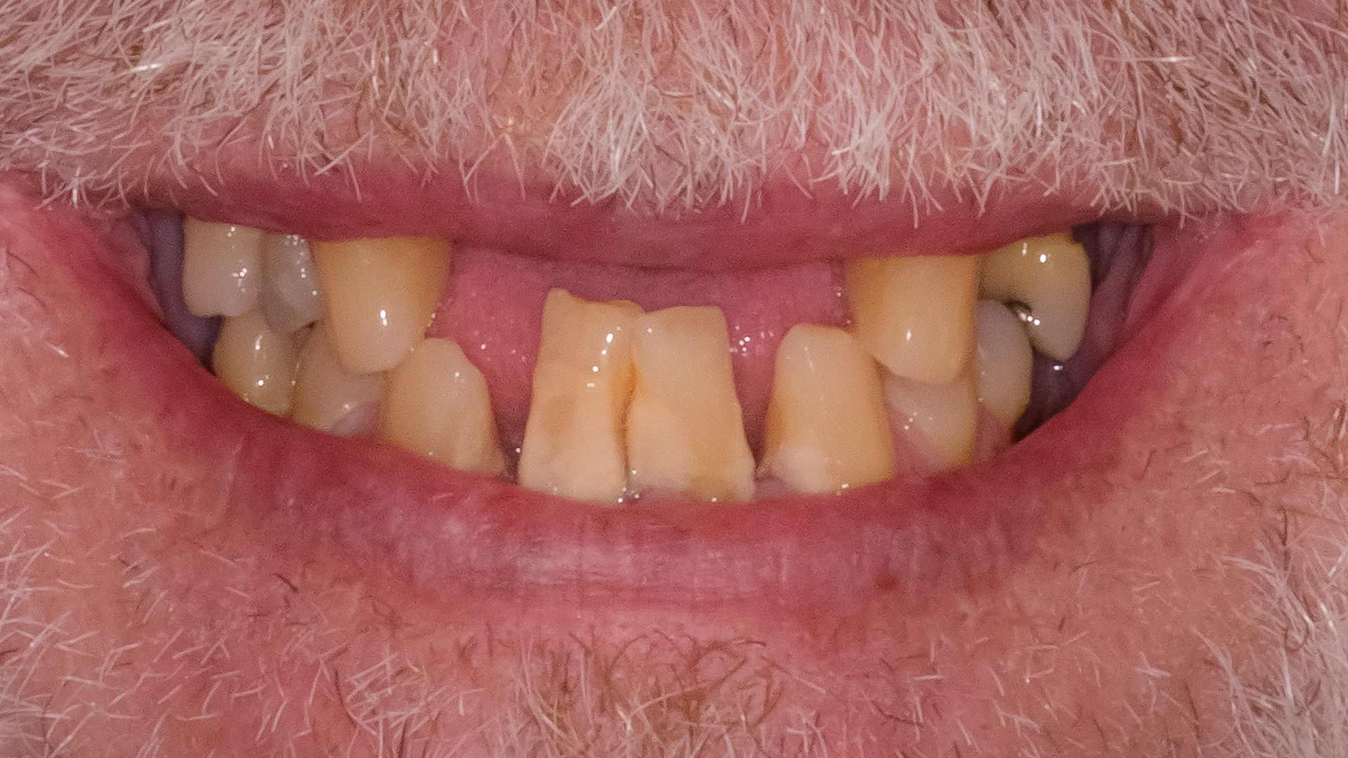 Before dental implant treatment
