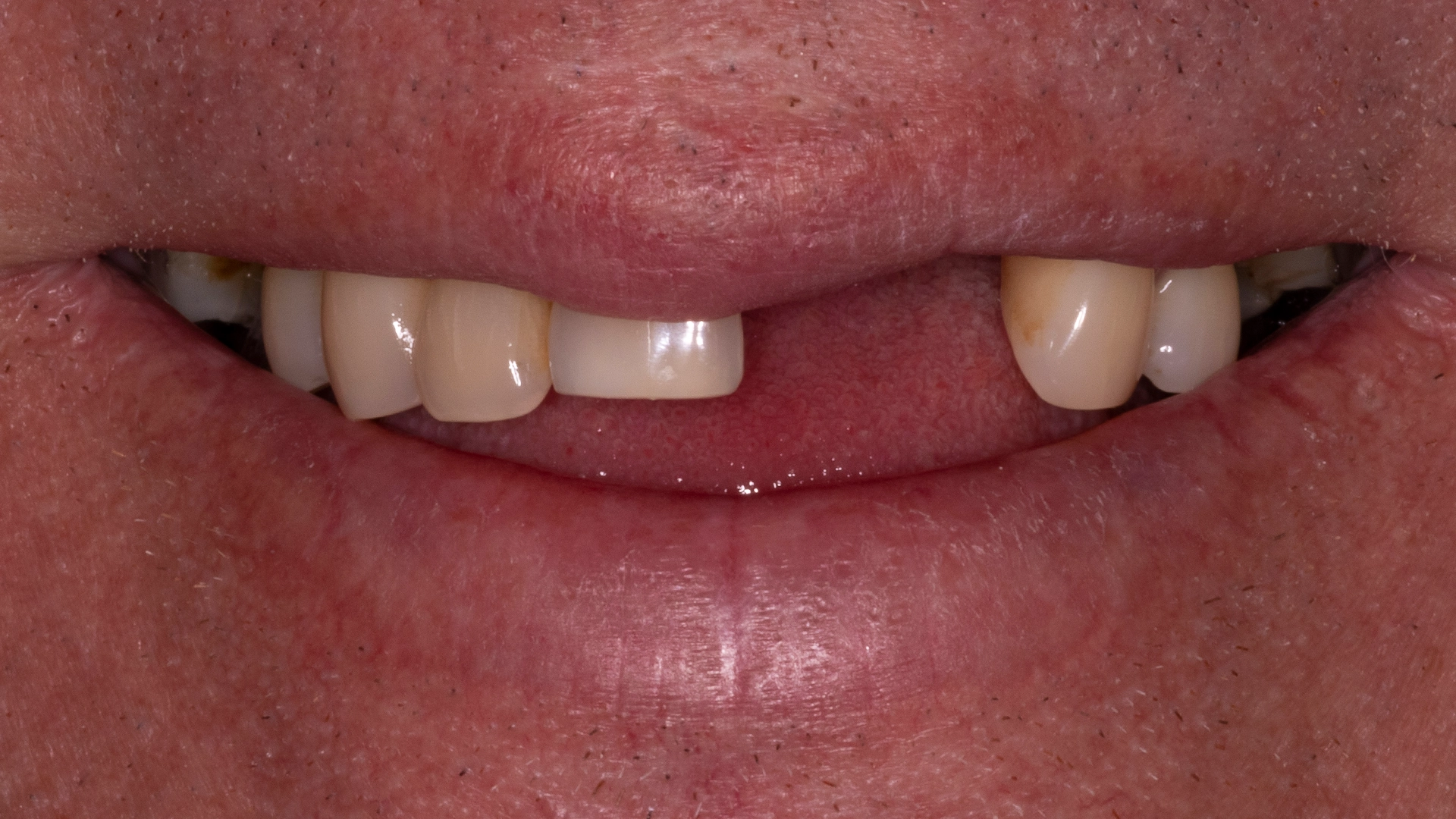 Before dental implant treatment at D'Amico Dental Care