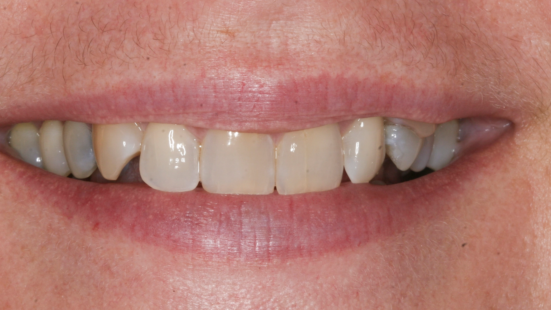 After smile transformation