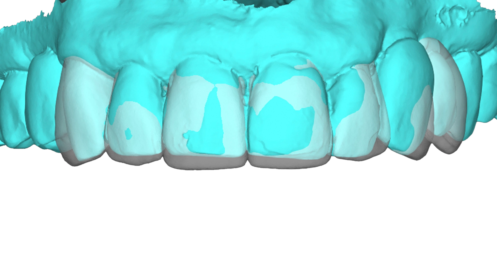 Digital Smile Design planning at D'Amico Dental Care – previewing veneer results before treatment