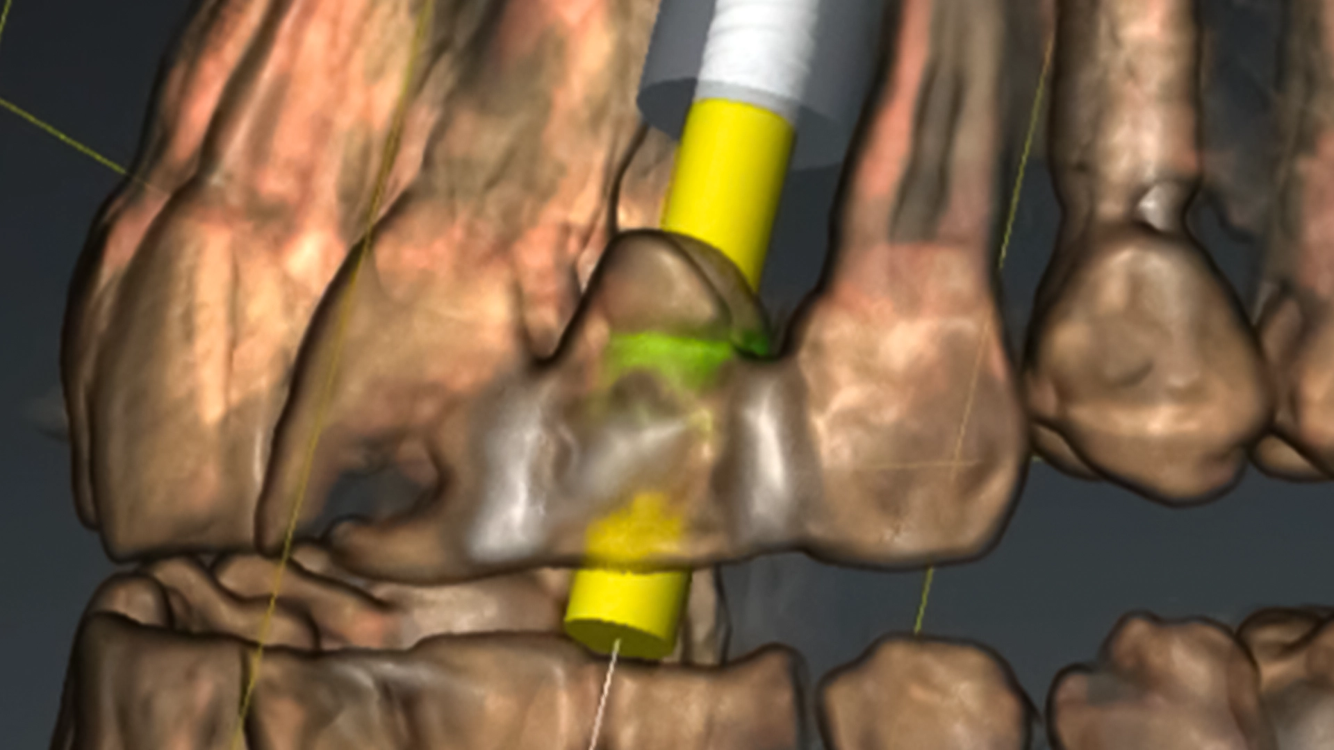 Digital implant planning with CBCT 3D imaging at D'Amico Dental Care Watertown MA