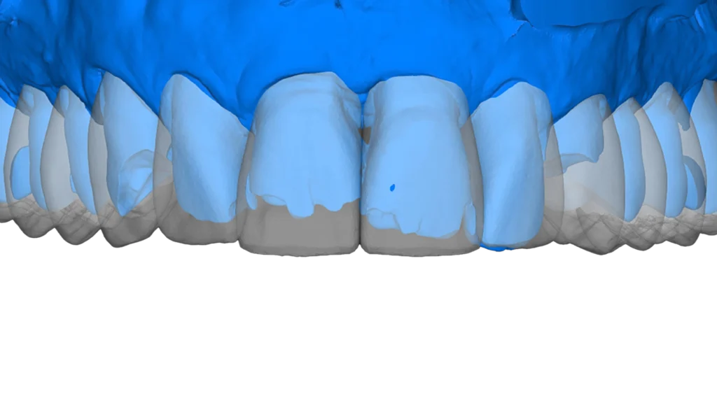 Smile design - digital planning for veneer