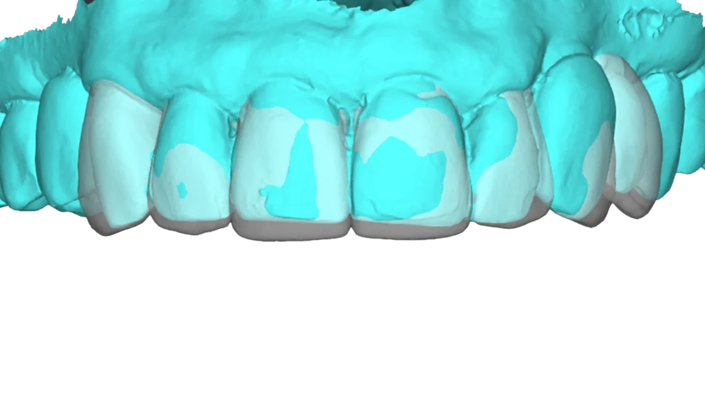 D'Amico Dental Care - Dental Veneers Explained: What They Are and the Different Types Available - Dental veneers are ultra-thin custom shells placed on the front of teeth to instantly improve color, shape, and alignment.