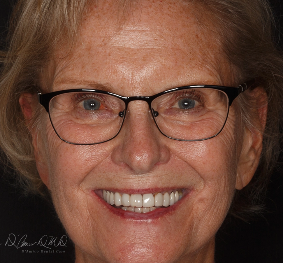 Before crown treatment at D'Amico Dental Care, Wayland and Watertown MA