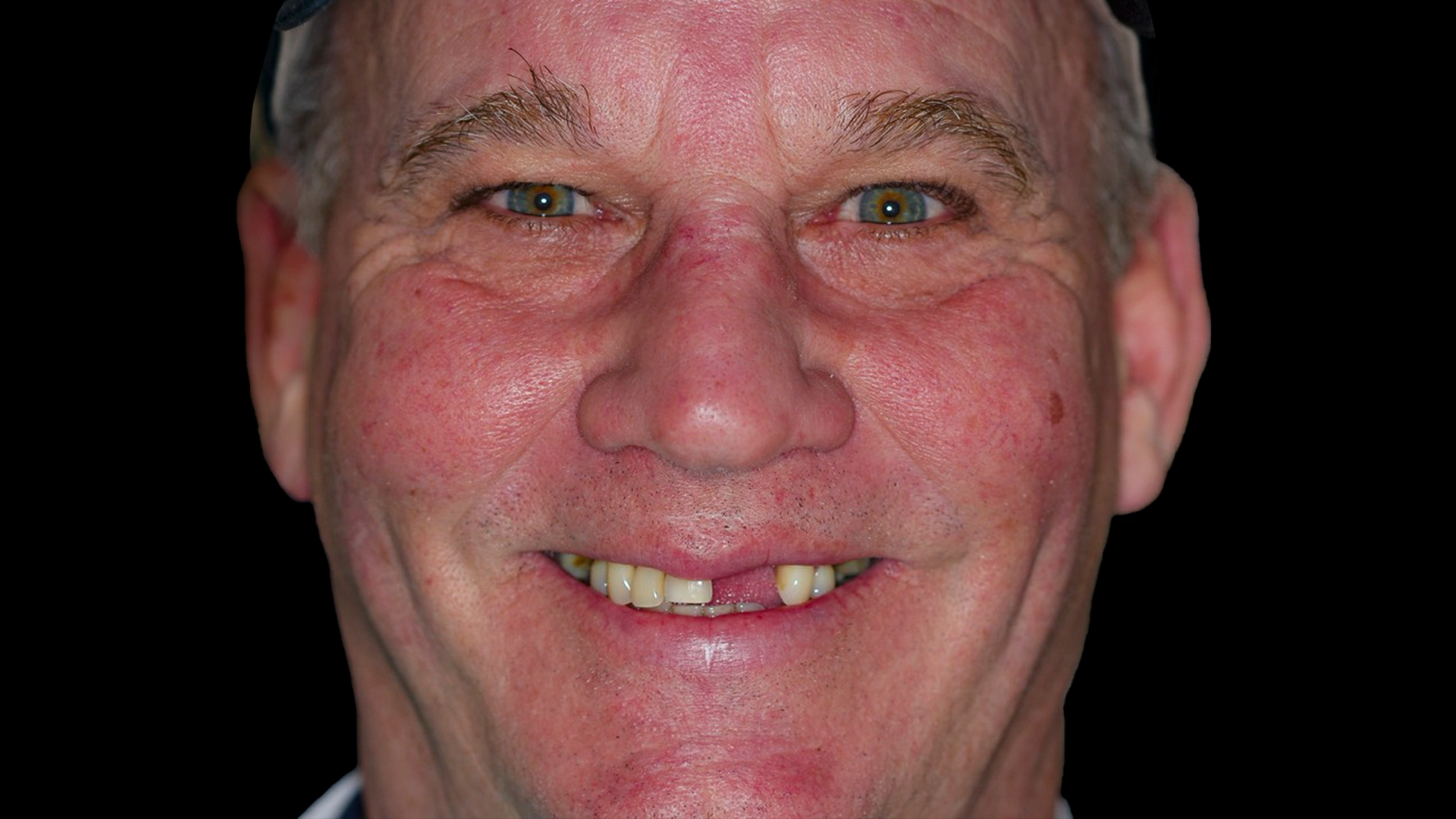 Before dental implant treatment – missing teeth requiring implant placement