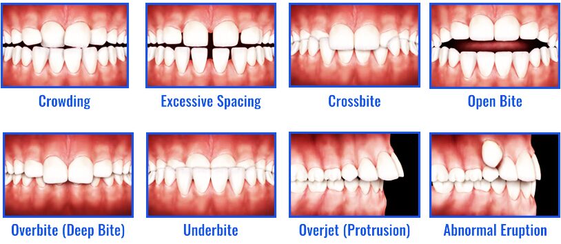 Common dental problems requiring orthodontic treatment