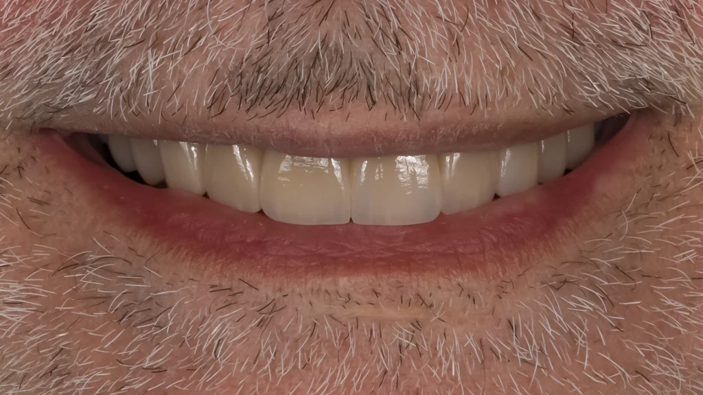 Natural-looking smile after porcelain veneer treatment at D'Amico Dental Care in Watertown, MA