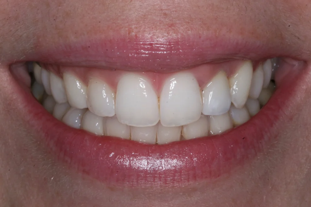 D'Amico Dental Care - Fastest Orthodontic Treatment in Wayland & Watertown MA: How D’Amico Dental Care Redefines Speed and Precision - Many orthodontic treatments take 18 to 24 months, but modern accelerated orthodontics can shorten that timeline significantly.