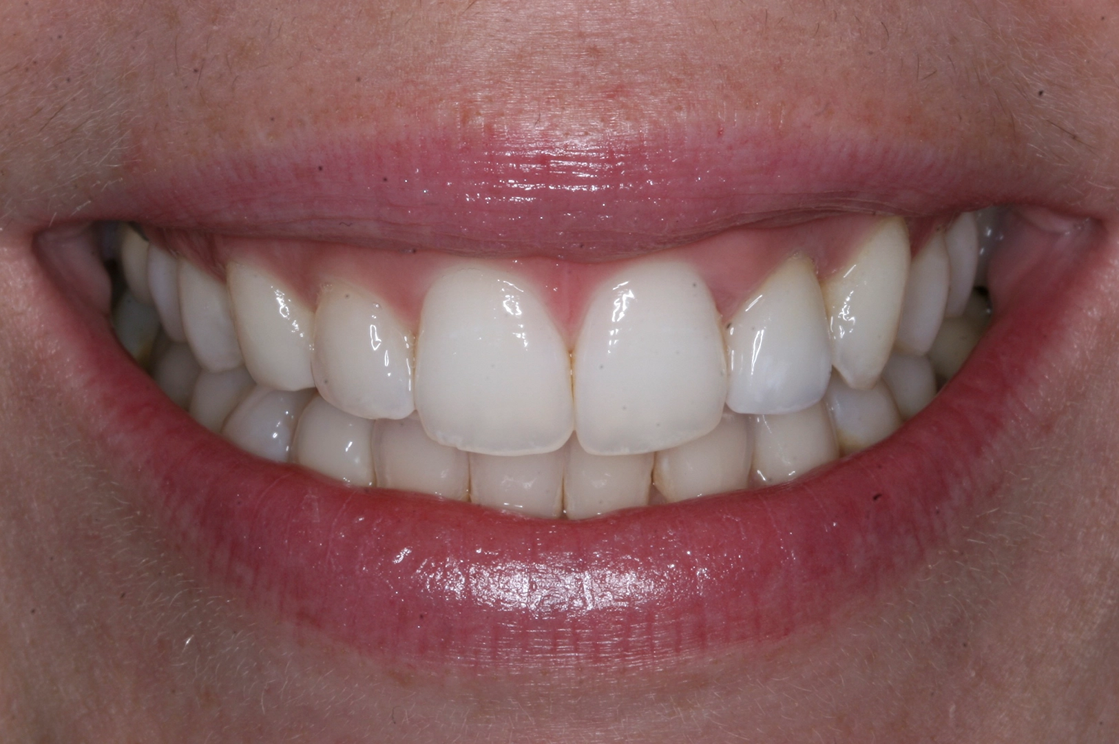 After smile transformation 2