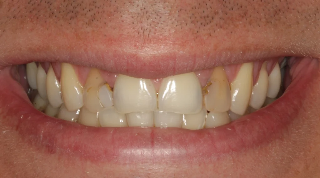 Worn and unevenly shaped front teeth before porcelain veneers at D'Amico Dental Care