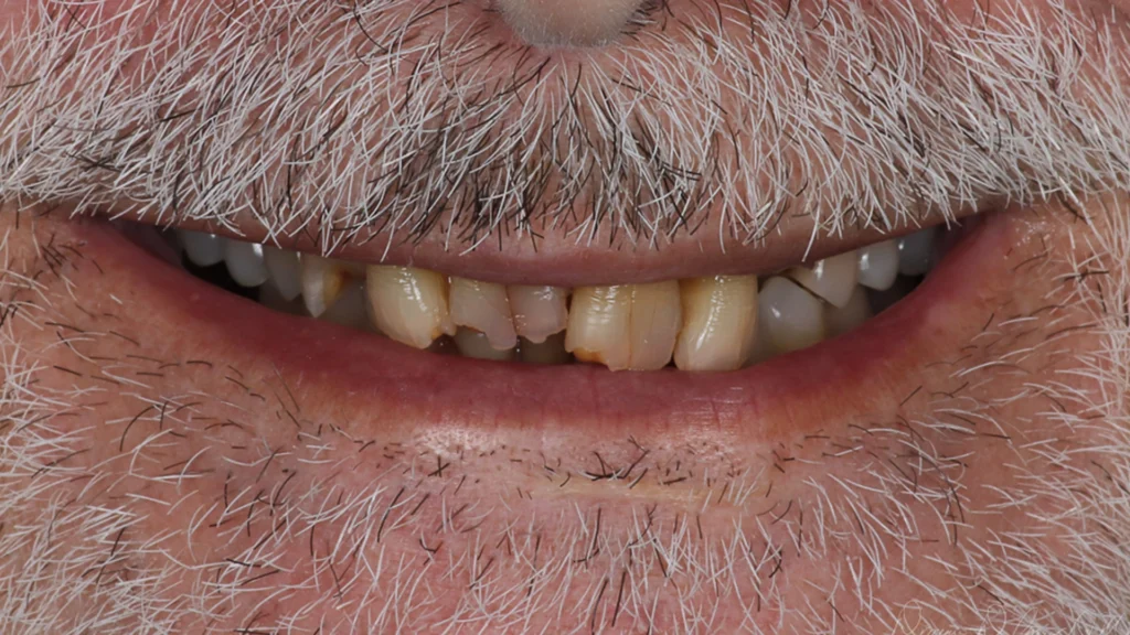 Discolored and uneven front teeth before porcelain veneers at D'Amico Dental Care