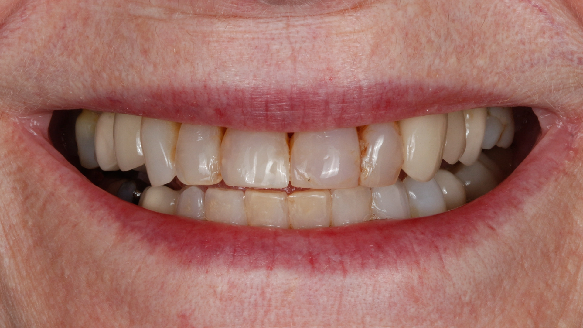 Before veneer treatment – teeth with cosmetic concerns prior to minimal-prep veneers