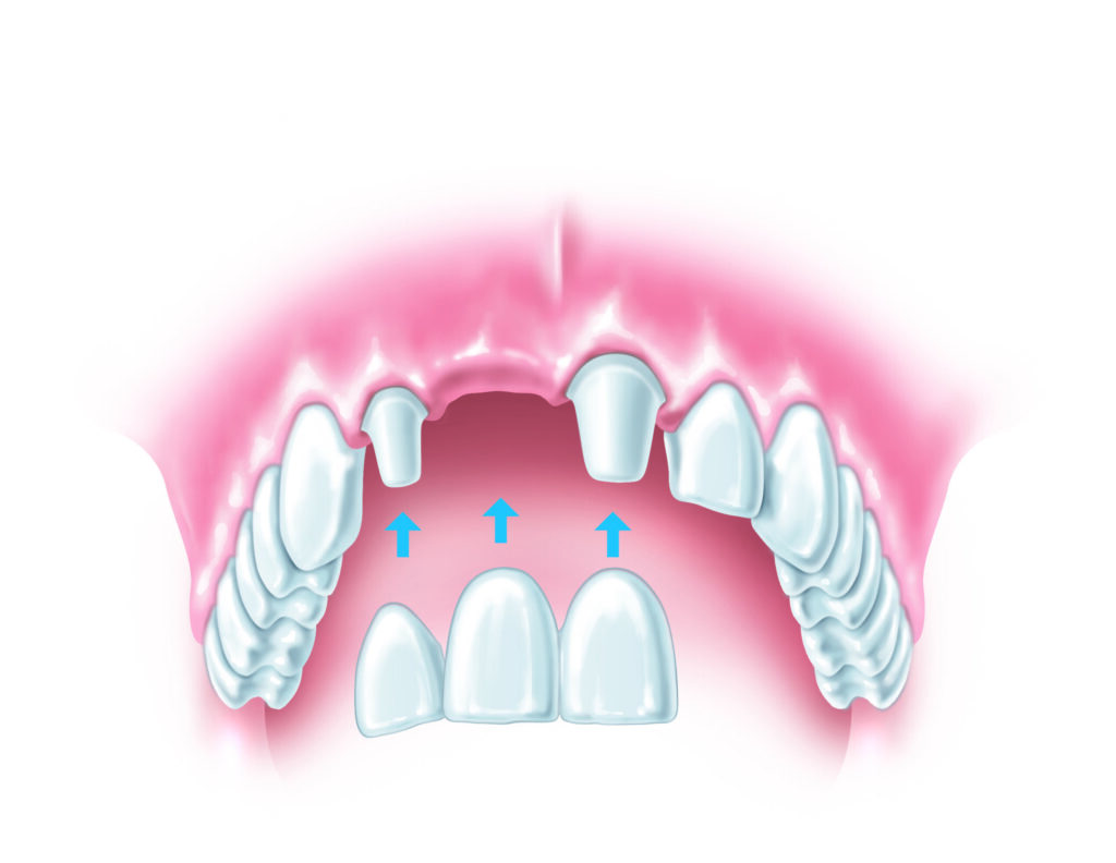 D'Amico Dental Care - What Happens If You Don’t Replace a Missing Tooth? Hidden Consequences & Expert Solutions in Wayland & Watertown MA - A missing tooth is not just a cosmetic issue. It triggers a chain reaction in your jawbone, bite, and facial structure.
