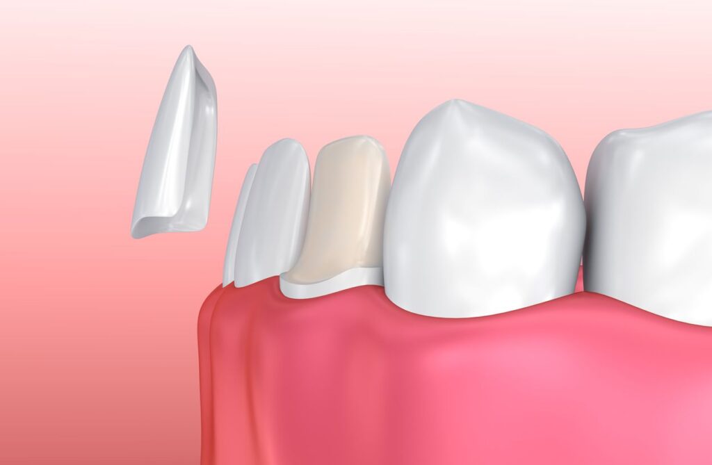 D'Amico Dental Care - Dental Veneers Lifespan: How Long They Really Last, What Shortens It - Most dental veneers last 10–20 years when designed and bonded correctly.