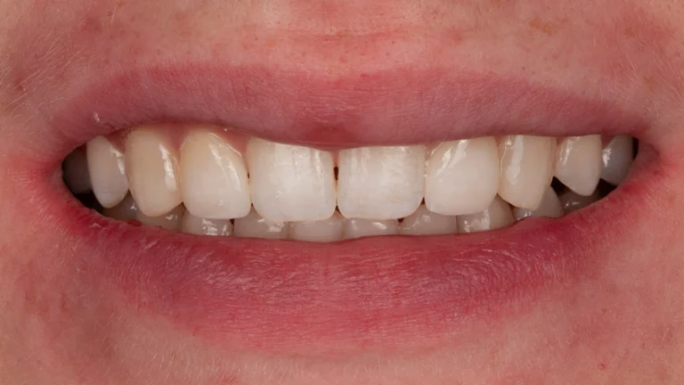 Best Types of Veneers