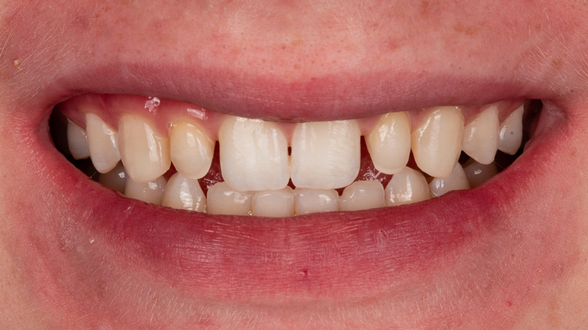 Before dental veneers