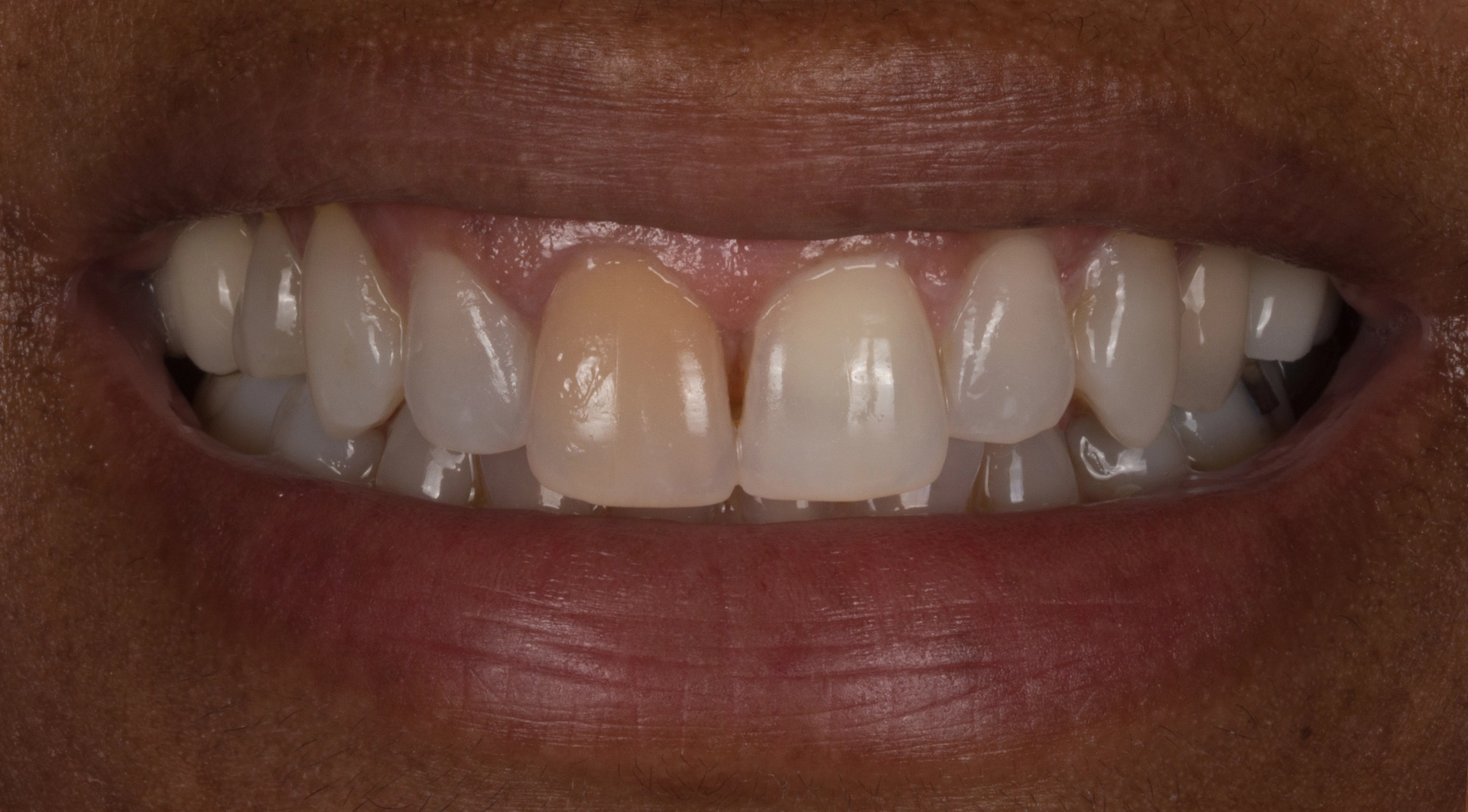 Before implant treatment
