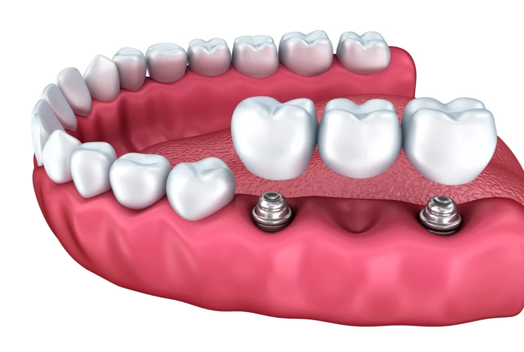 D'Amico Dental Care - Missing Multiple Teeth? Compare Wayland & Watertown, MA 's Top Restoration Options at D’Amico Dental Care: Your Guide to a Permanent, Natural Smile - Missing several teeth is more than just a cosmetic concern. Over time, it can lead to jawbone deterioration, changes in facial structure, and a noticeable loss of confidence.