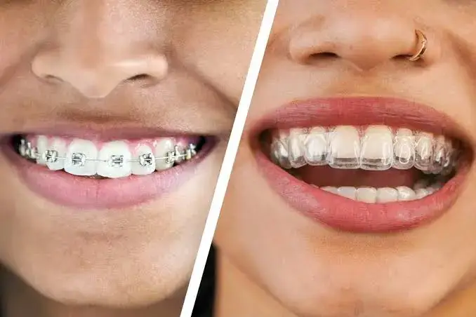D'Amico Dental Care - Magazine - Quick Summary Veneers do not damage healthy teeth when planned correctly. Modern veneers typically require...