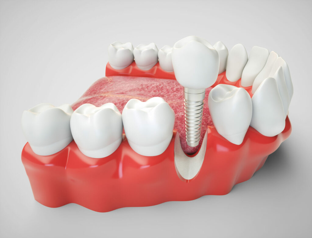 D'Amico Dental Care - Implant Longevity Guide | D’Amico Dental Care - A dental implants is not just a replacement tooth. It is a biological system built to live inside your mouth for the long term. That is why many patients feel relieved when the implant is placed, then quietly worry again a few years later: "Will it still be strong? Will it get infected? What if I ruin it by cleaning wrong?"