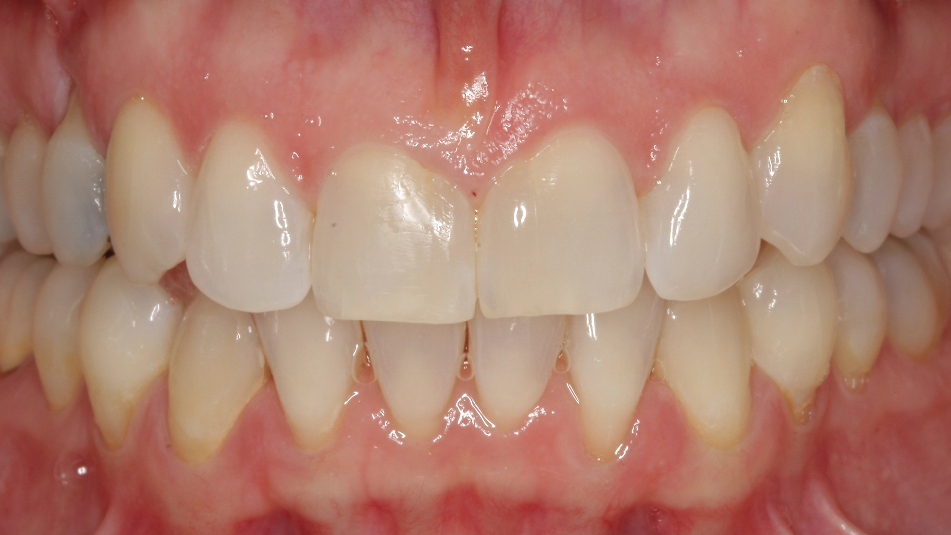 After dental implant treatment at D'Amico Dental Care Wayland Watertown MA — restored confident smile