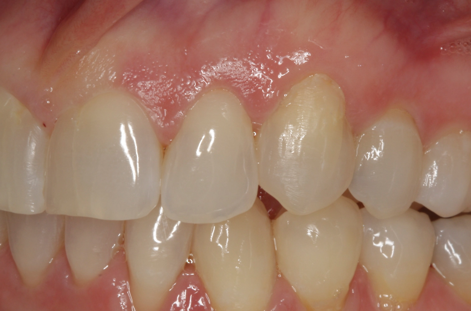 After fast-track orthodontic treatment result at D'Amico Dental Care Wayland Watertown MA