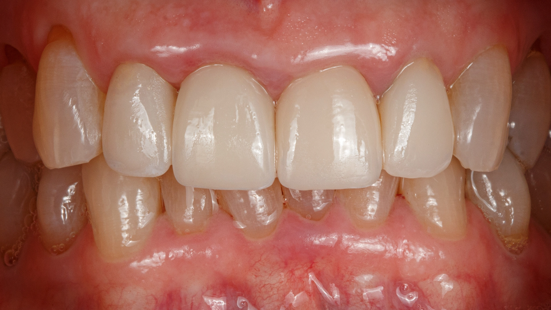 After full-mouth implant treatment D'Amico Dental Care Wayland Watertown MA