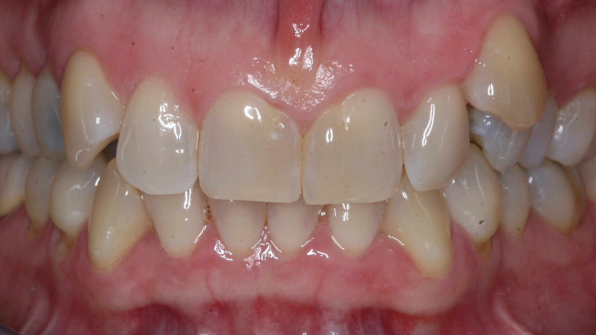 Before dental implant treatment at D'Amico Dental Care Wayland Watertown MA — patient smile transformation