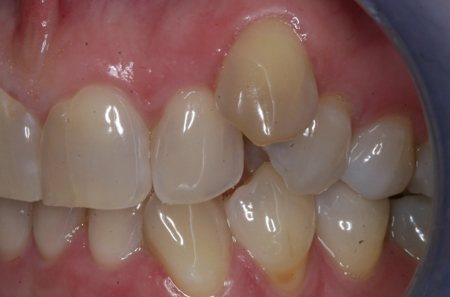 Before fast-track orthodontic treatment at D'Amico Dental Care Wayland Watertown MA