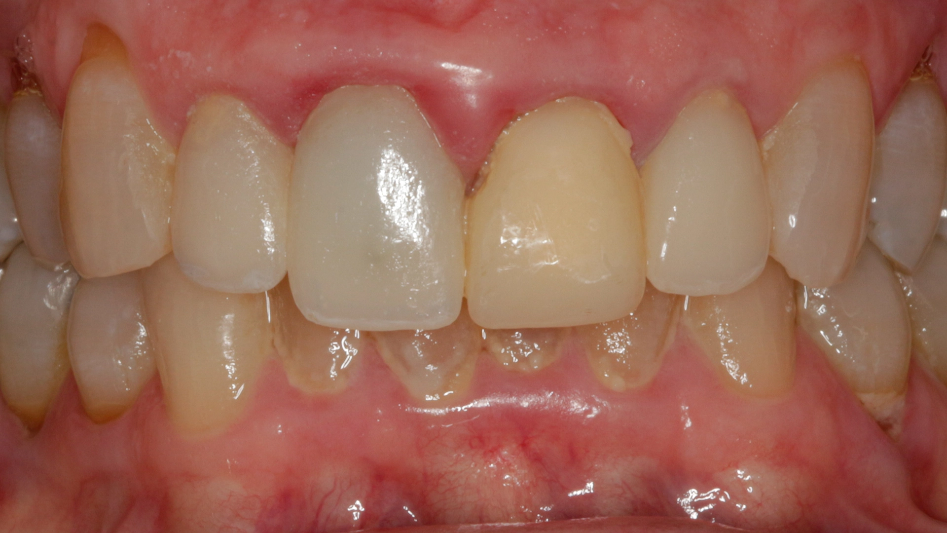 Before full-mouth implant treatment D'Amico Dental Care Wayland Watertown MA
