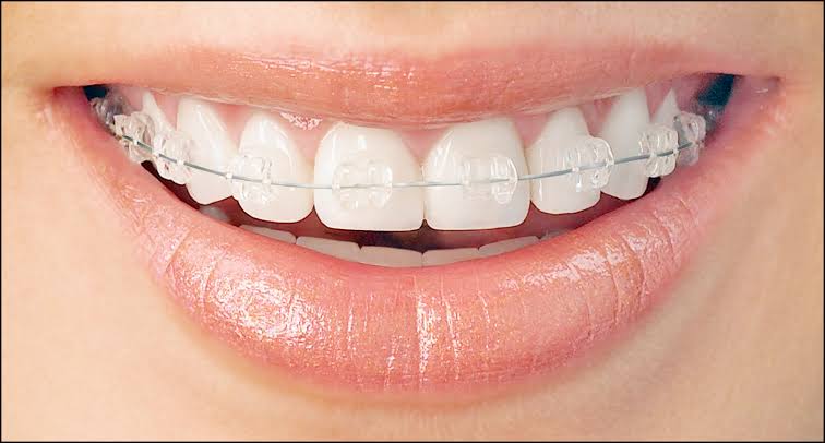 D'Amico Dental Care - Magazine - Quick Summary Veneers do not damage healthy teeth when planned correctly. Modern veneers typically require...