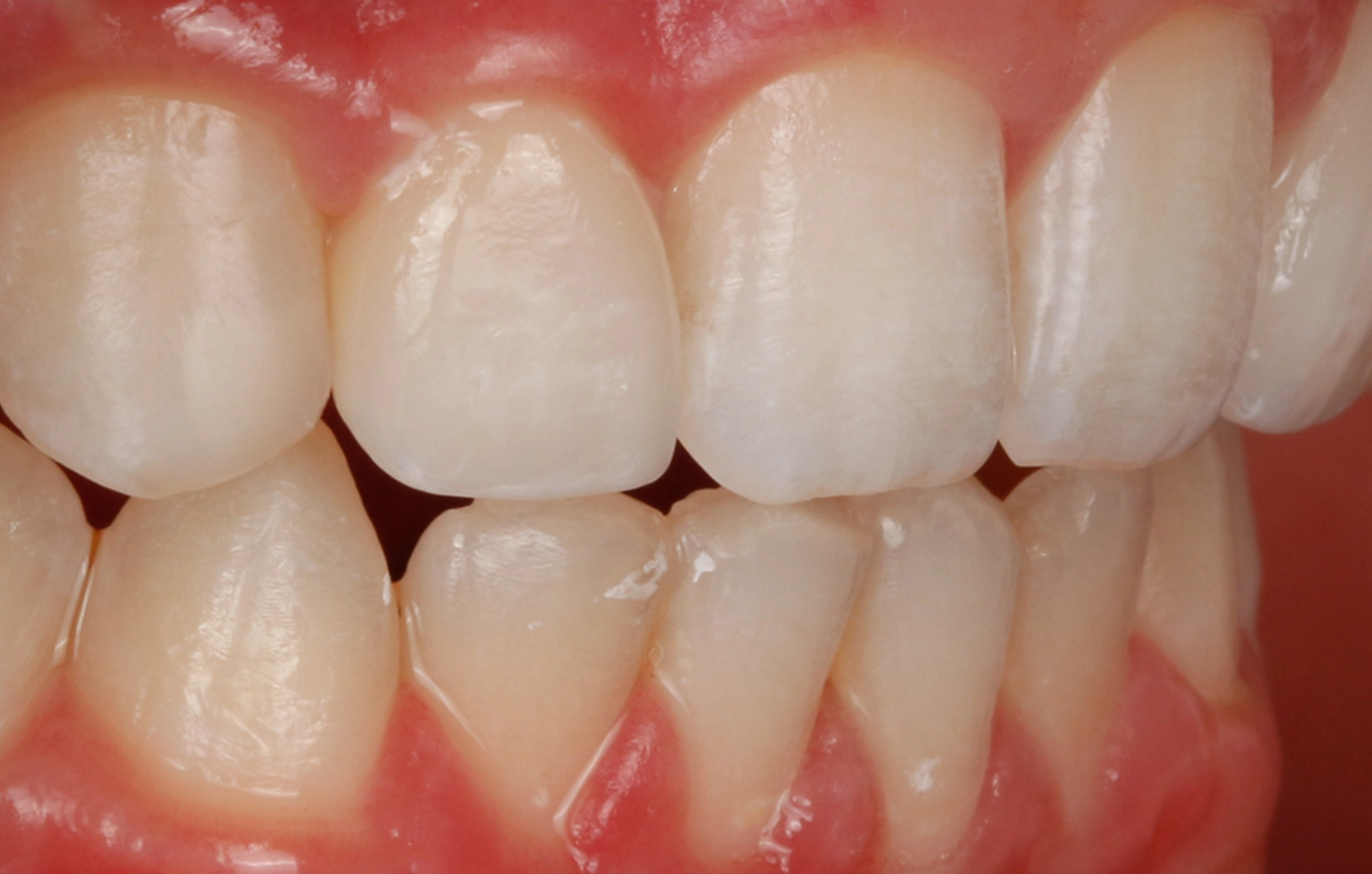 Cosmetic dentistry result D'Amico Dental Care Wayland Watertown MA