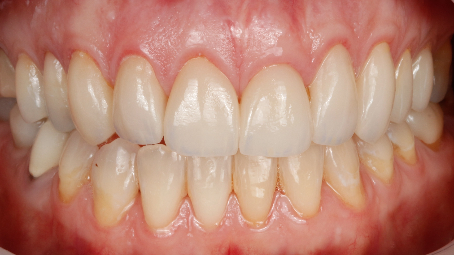 Smile transformation result D'Amico Dental Care Wayland Watertown MA