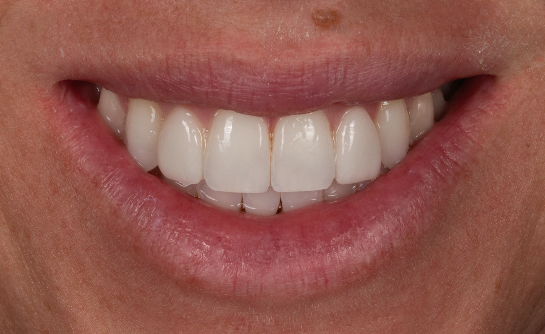 Same-day crown smile result D'Amico Dental Care Wayland Watertown MA