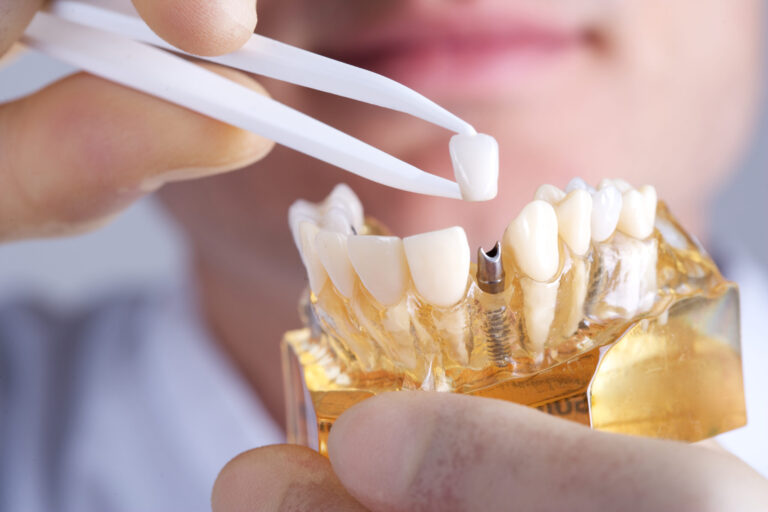 D'Amico Dental Care - Magazine - Quick Summary Veneers do not damage healthy teeth when planned correctly. Modern veneers typically require...