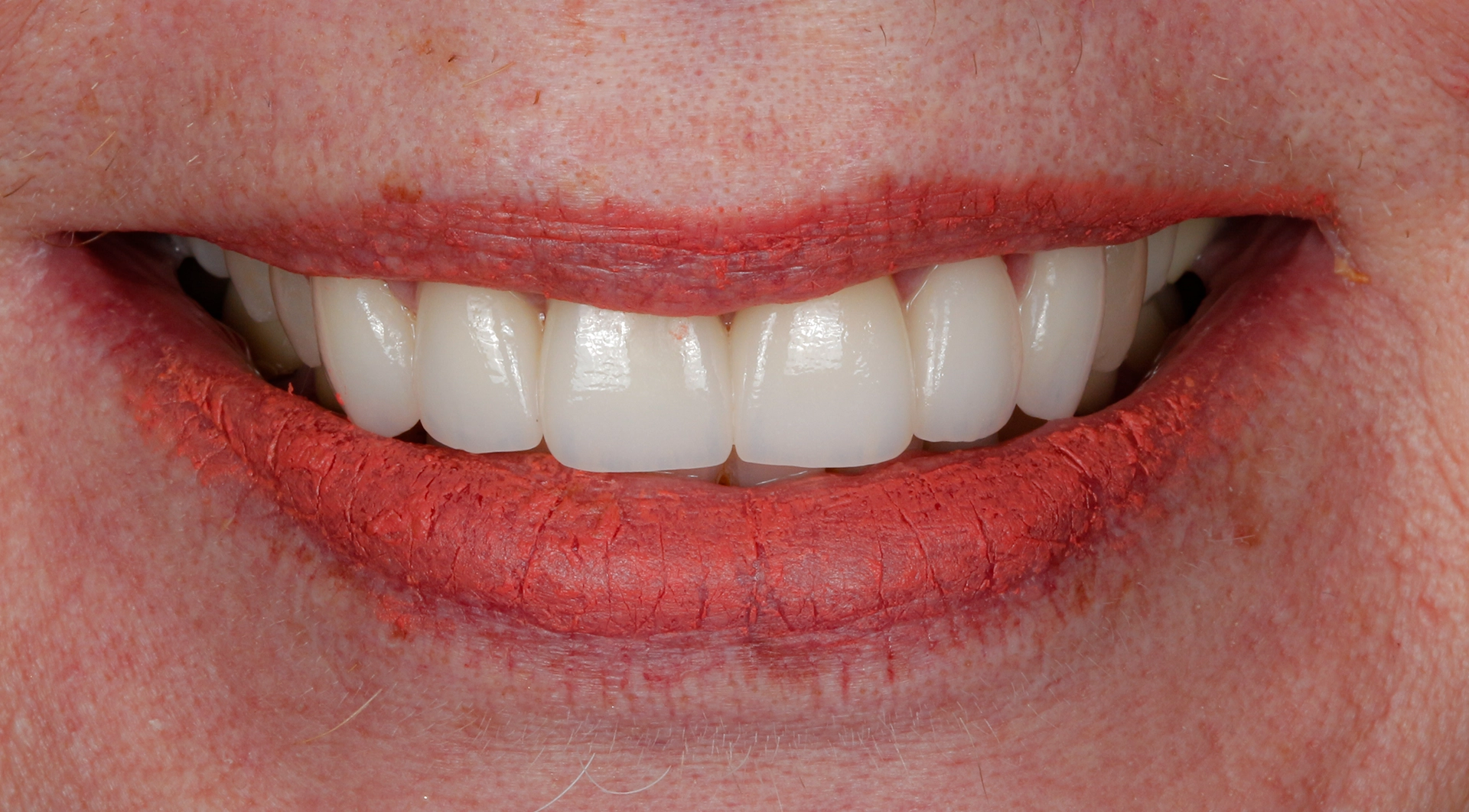 Composite bonding smile result D'Amico Dental Care Wayland Watertown MA